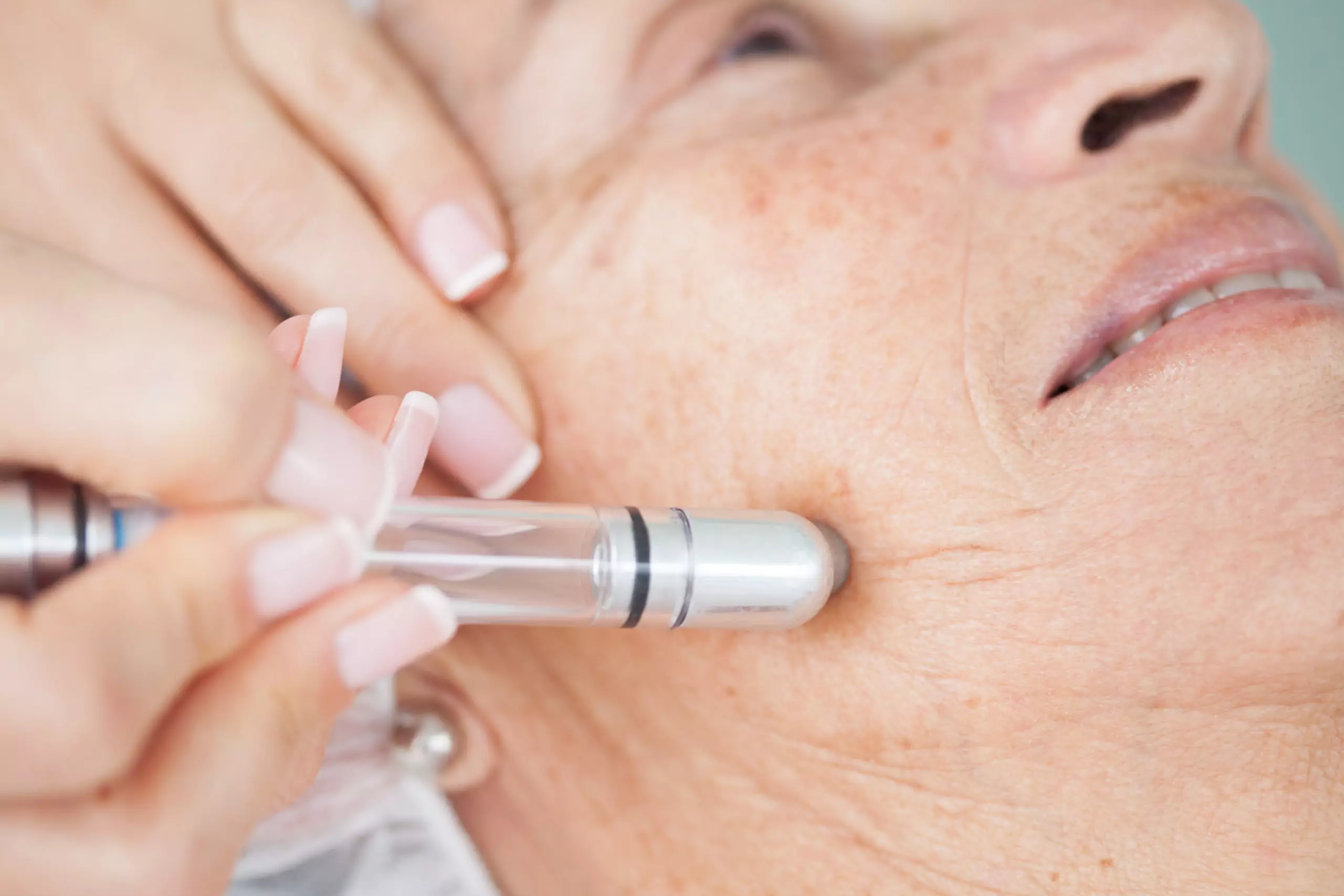 Microdermabrasion Kansas City