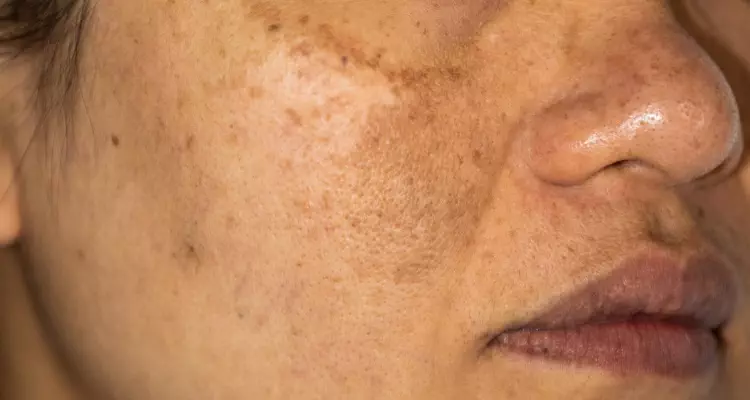 Get Rid of Hyperpigmentation in Kansas City