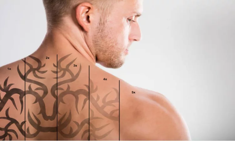 Laser Tattoo Removal Cost Kansas City