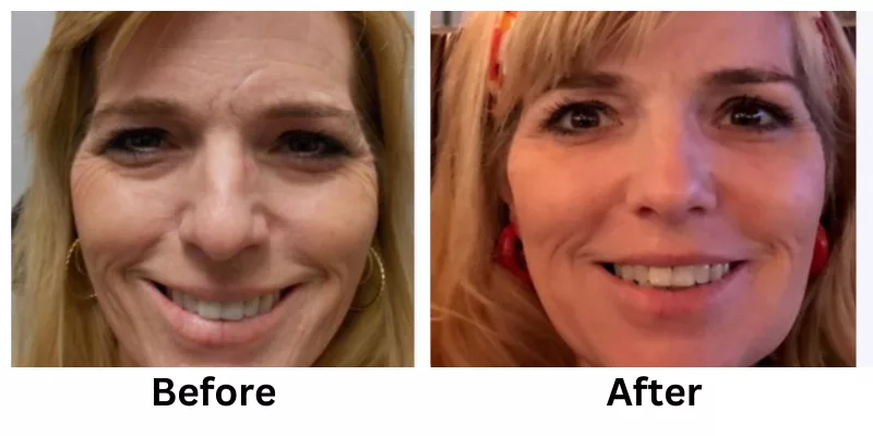 Liquid Facelift Before & After