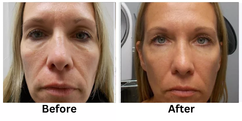 Skin Rejuvenation Before And After Pictures