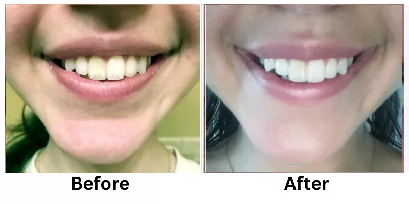 Teeth Whitening Before And After Pictures