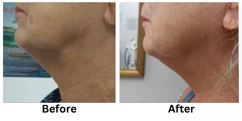 Skin Tightening Before And After