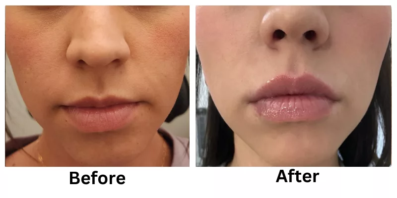 Lip Filler Before and After