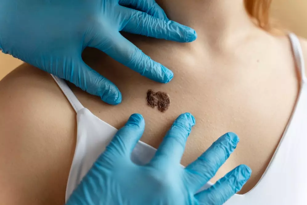 Moles and Lesion Removal